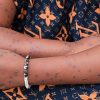SANTÉ PUBLIQUE : Un cas de Mpox guéri, inquiétude face aux décès à Tamba !